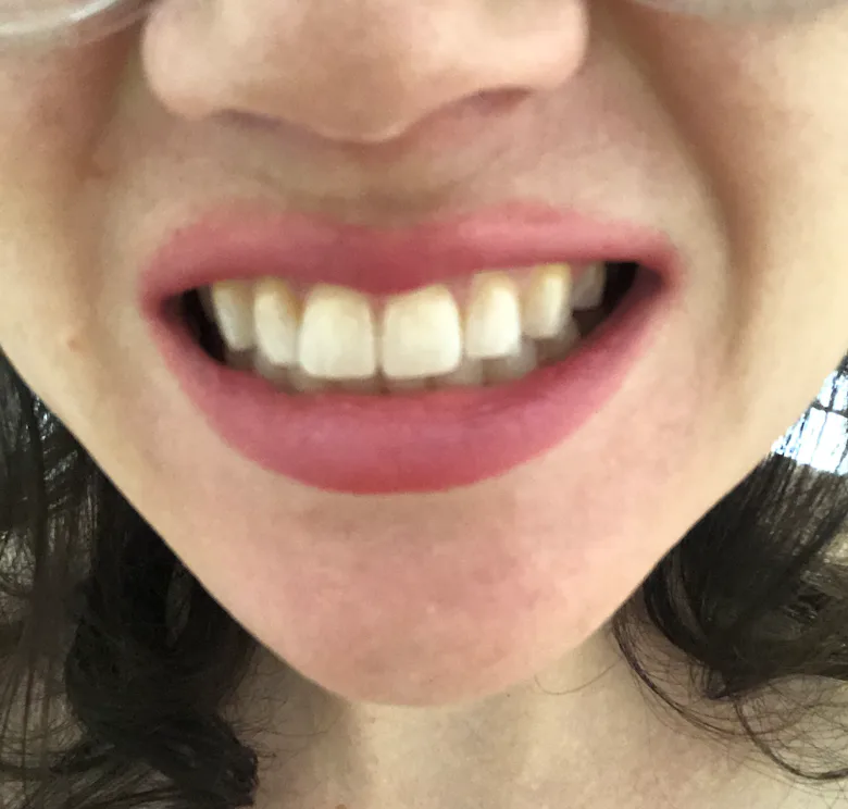 Bussel Teeth My Teeth Got The A-List Treatment With Smile Brilliant's Whitening System
