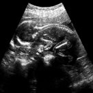 Ultrasound image of a fetus in the womb.