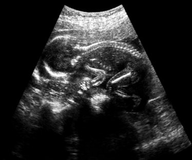 Ultrasound image of a fetus in the womb.