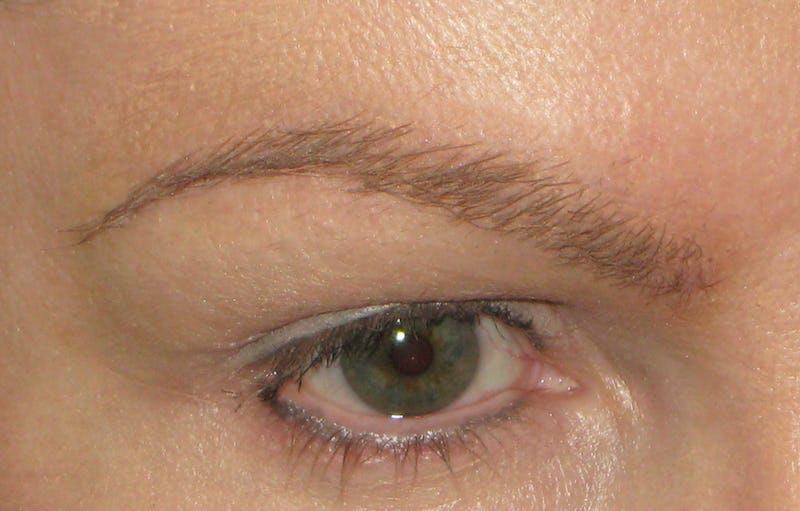 eyebrow transplant after