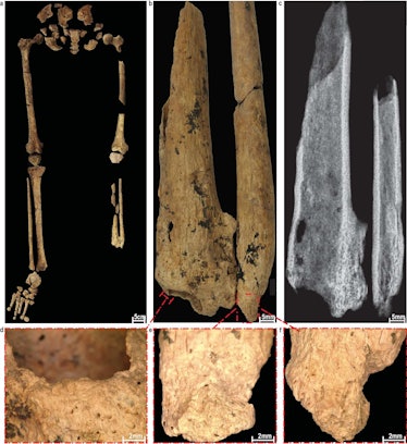 skeleton showing first recorded amputation  