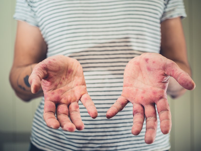 Shot of an adult's palms with red rash on them, in a story answering the question, why is hand, foot...