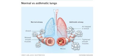 diagram of lungs suffering from asthma