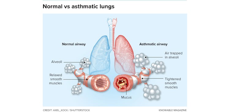 diagram of lungs suffering from asthma
