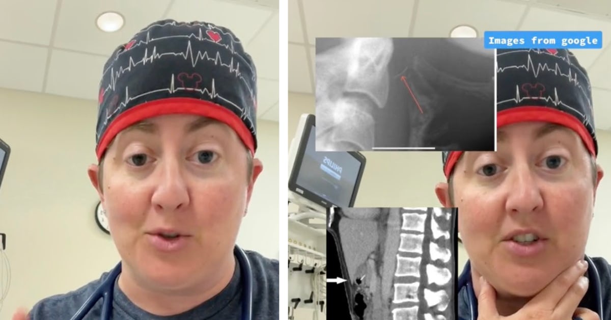 A Doctor Warns Parents About Grill Brushes After Boy Swallows Wire