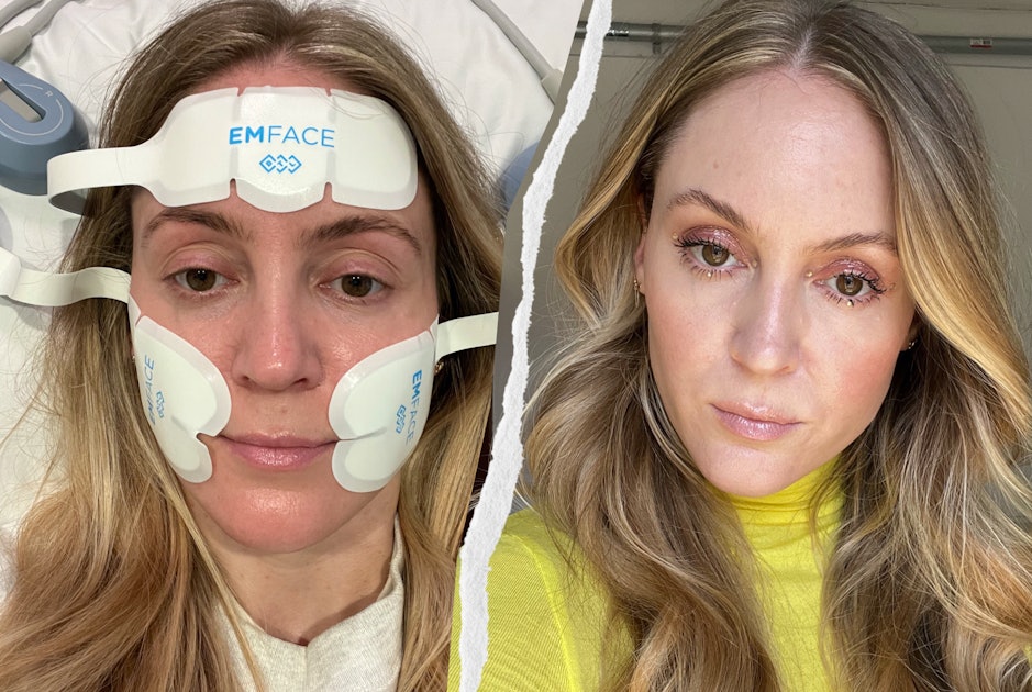 Emface Review 2024: I Tested the Needle-Free Filler Skincare Device