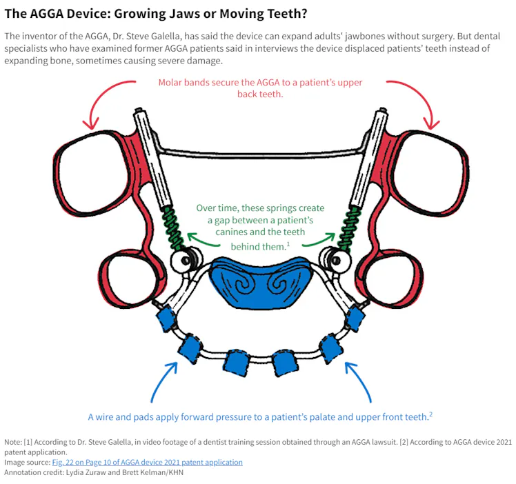 Coach Agga This Dental Device Was Sold to Patients To Fix Their Jaws — Now, Their ...