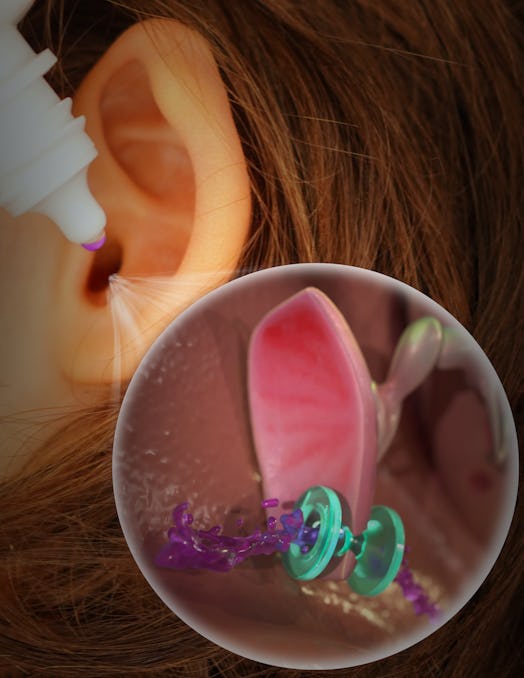 An illustration of the new ear tube, which can deliver antibiotics, in a child's ear.