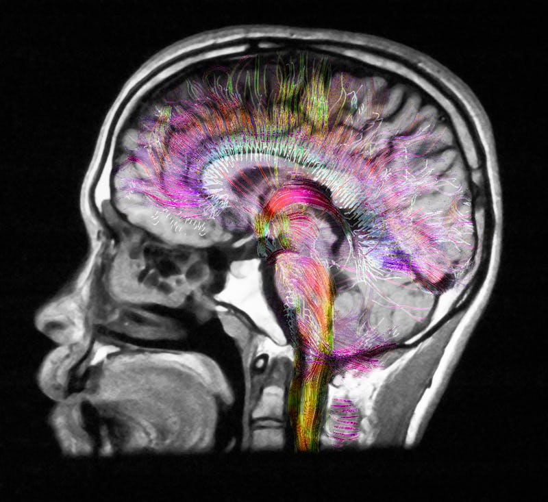Diffusion MRI, also referred to as diffusion tensor imaging or DTI, of the human brain