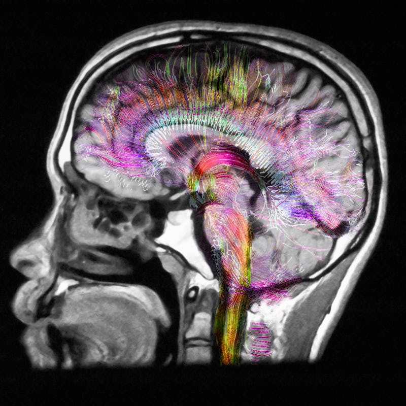 Diffusion MRI, also referred to as diffusion tensor imaging or DTI, of the human brain