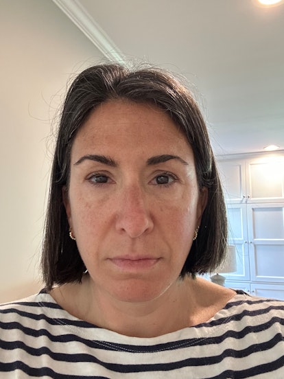 results of lower eyelid surgery 