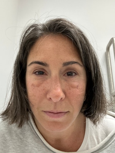 results of lower eyelid surgery 