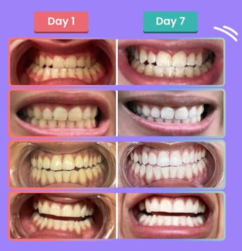 DrDent Professional Teeth Whitening Strips (21 Treatments)