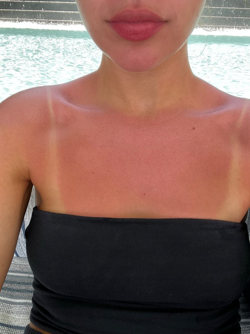 Photo proof of a sunburn in St Kitts