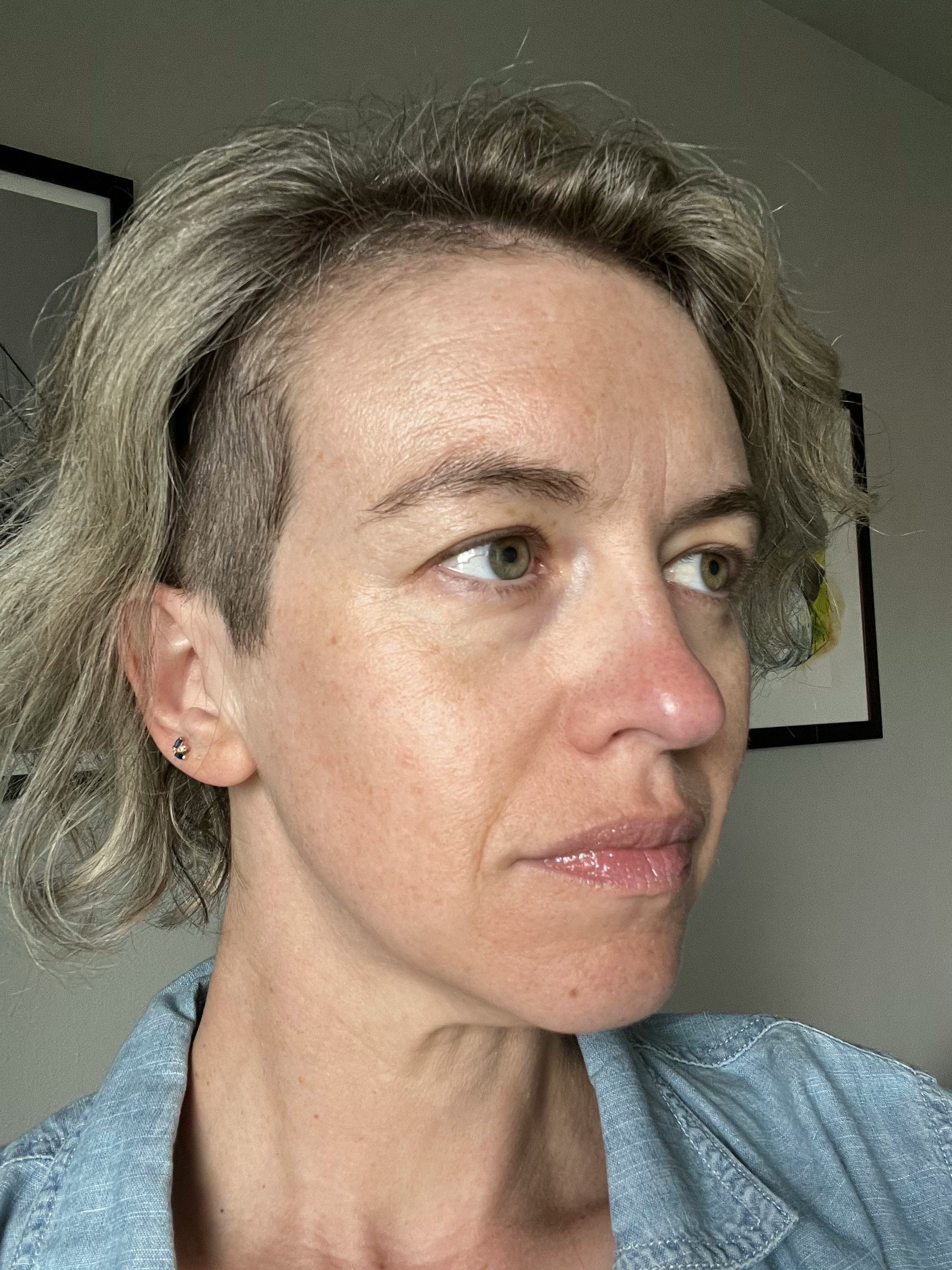 Skin Laundry The Fixer Review A NeedleFree Botox Alternative For