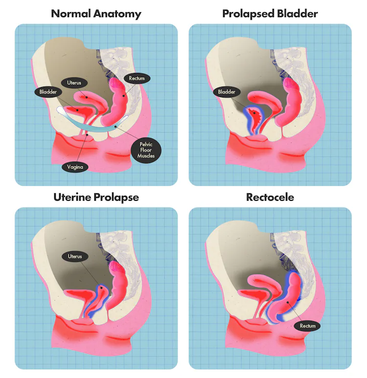 Prolapzo Rectal Prolapse Is More Common Than You Think — Here’s How I Finally ...