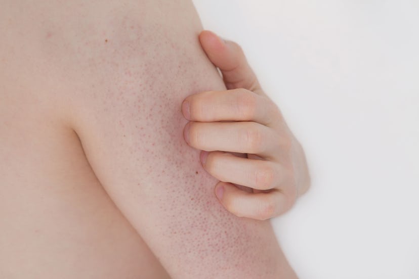 Young boy scratches a keratosis pilaris patch on his arm, in a story about keratosis pilaris in babi...
