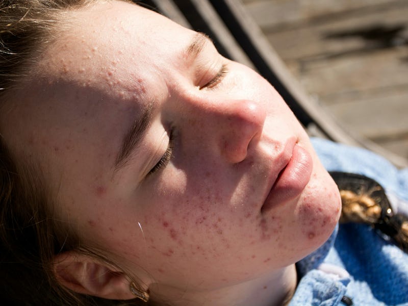 There’s no evidence sunlight can cure acne.