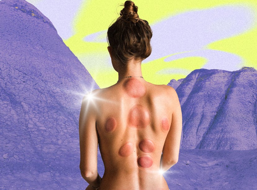 I Tried Cupping For The First Time & It Was Worth The Bruises