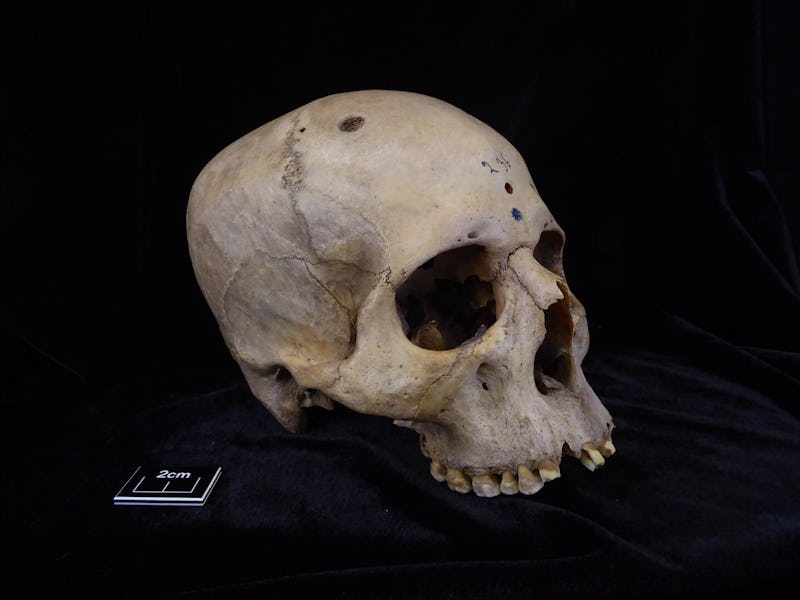 Skull and mandible 236, dating from between 2687 and 2345 BCE, belonged to a male individual aged 30...