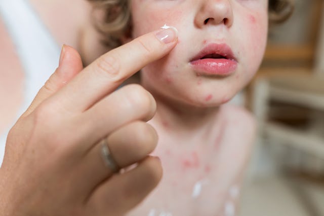 A woman puts antibiotic cream on her kid's skin infection.