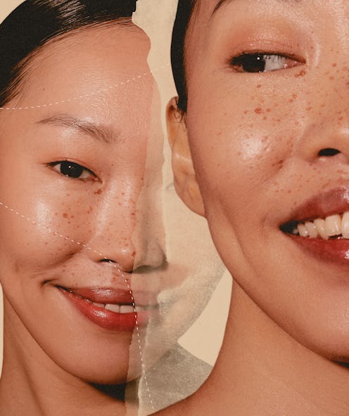 Dimpleplasty Is A Procedure That Adds Dimples To Your Face