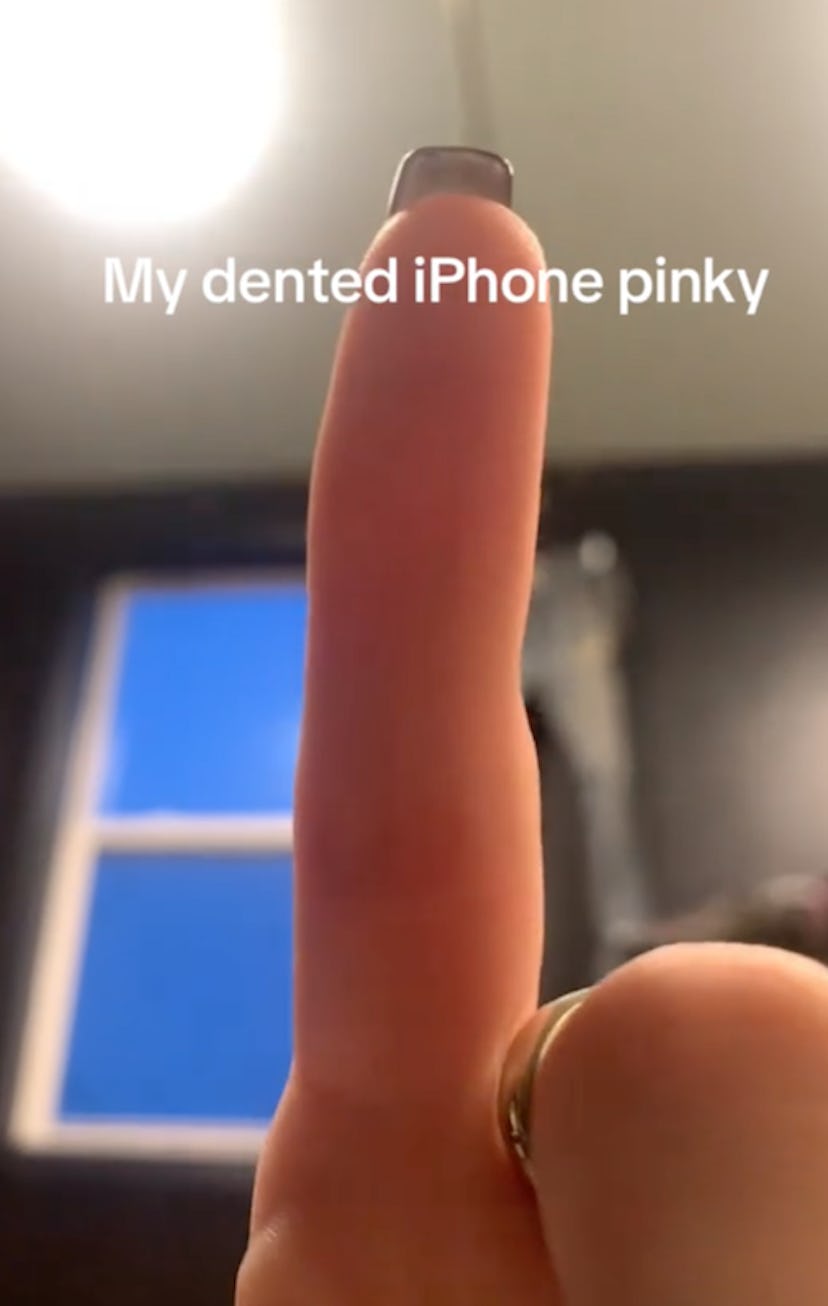 Is "smartphone pinky" real?