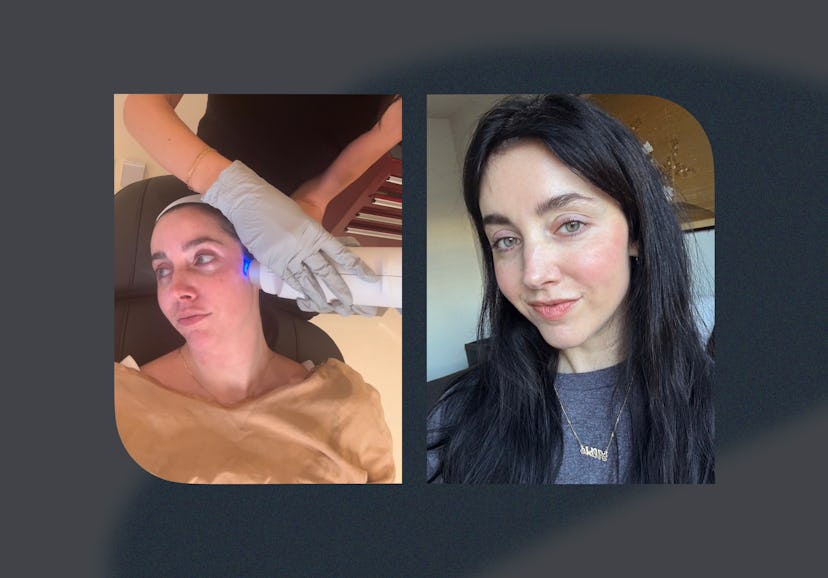An honest review of the buzzy Miria laser, which rejuvenates the skin for major tightening and brigh...