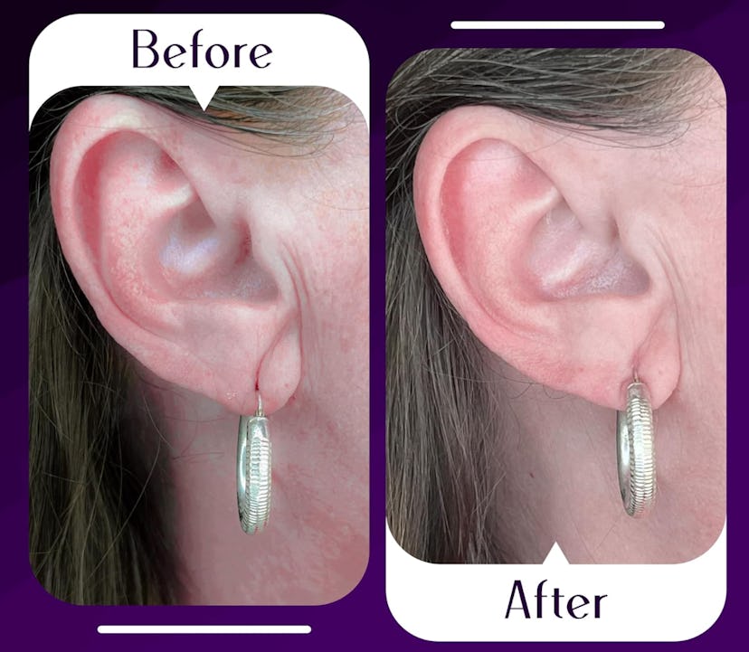 Lobe Wonder Support Patch (60 Pieces)