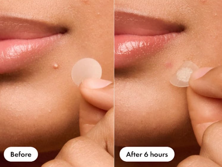 Hero Cosmetics Mighty Patch