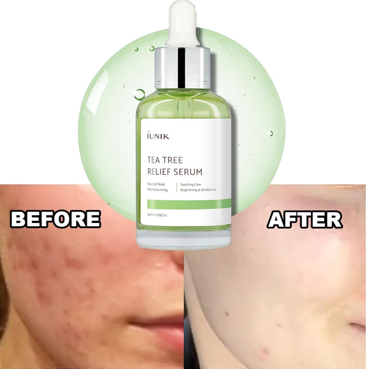 IUNIK Tea Tree 67% Relief Facial Serum