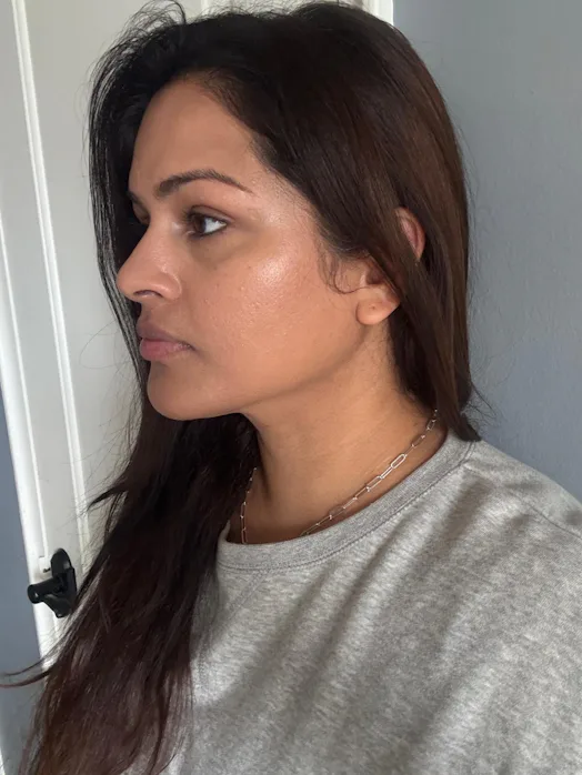 InMode's Forma Skin Tightening Treatment Gave Me A Snatched Jawline
