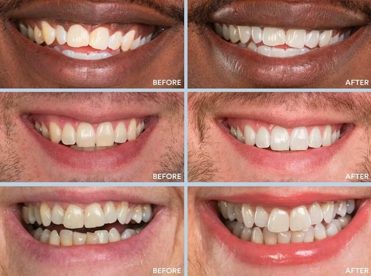 Auraglow Extra Strength Teeth Whitening Pen