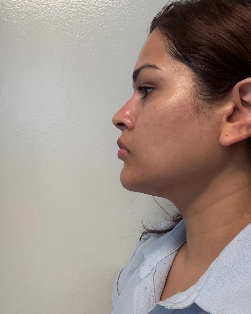 InMode's Forma Skin Tightening Treatment Gave Me A Snatched Jawline