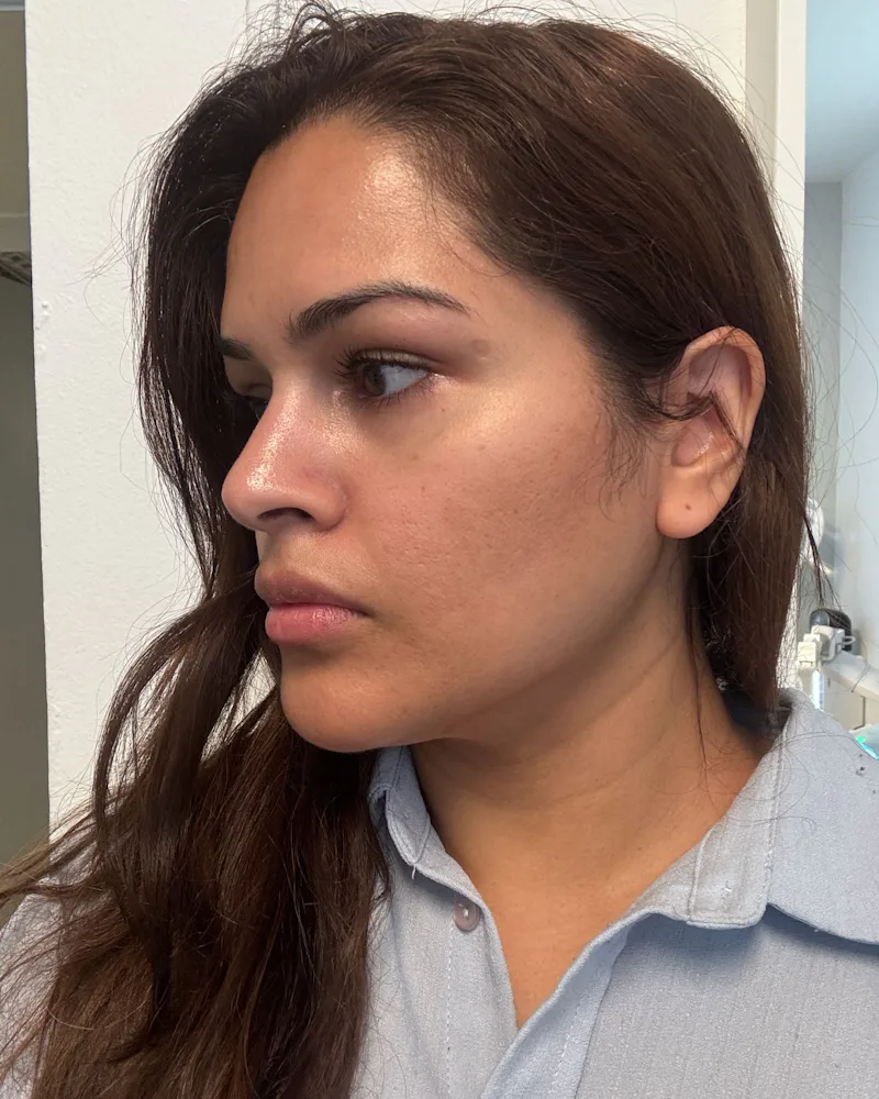 InMode's Forma Skin Tightening Treatment Gave Me A Snatched Jawline