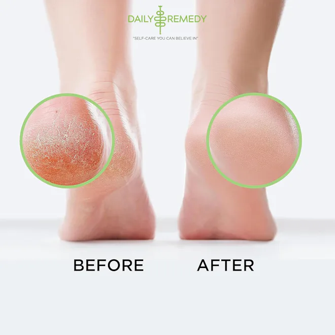 DAILY REMEDY Tea Tree Oil Foot Soak