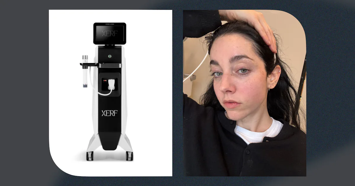 This No-Downtime Treatment Lifted My Cheekbones In 45 Minutes Flat