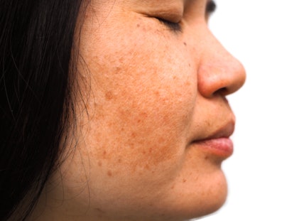 Melasma and freckle on woman face      