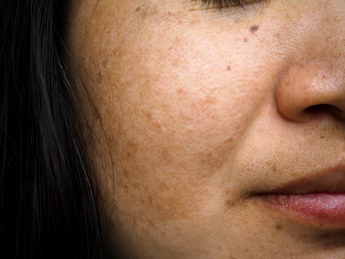 Melasma and freckle on woman face      