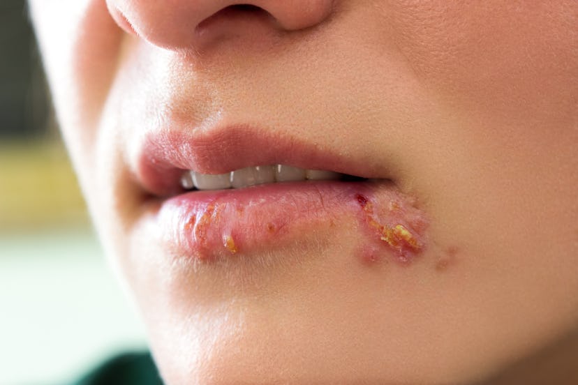 Girl lips showing herpes blisters. Herpes is one of the most common, and most stigmatized, viruses i...