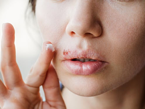 Part of a young woman's face with a virus herpes on lips, treatment with ointment