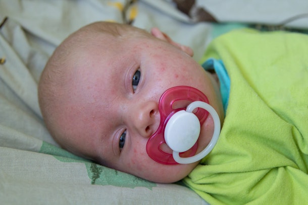 Why Do Babies Get Acne A Pediatrician Explains