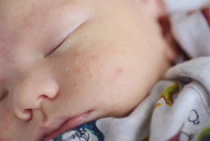 a newborn baby with a baby rash in soft focus