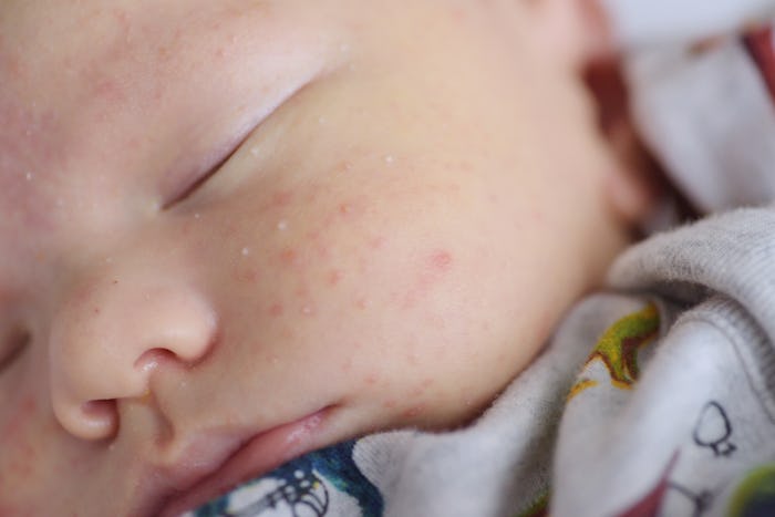 a newborn baby with a baby rash in soft focus