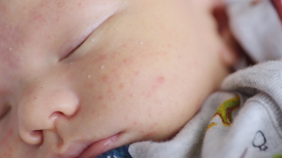 Why Do Babies Get Acne A Pediatrician Explains
