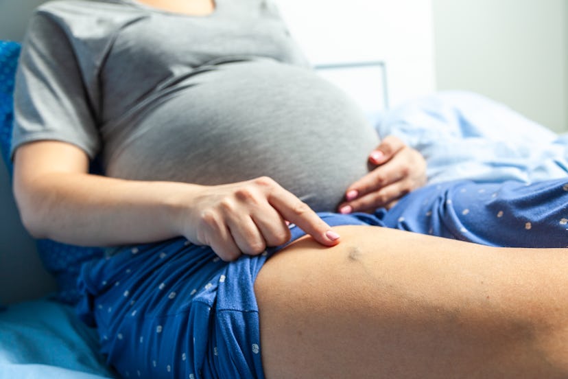 Varicose veins in pregnant women. Woman sits on bed and points her finger at swollen veins.