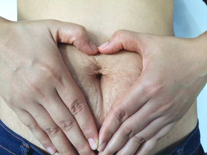 Stretch marks on white background