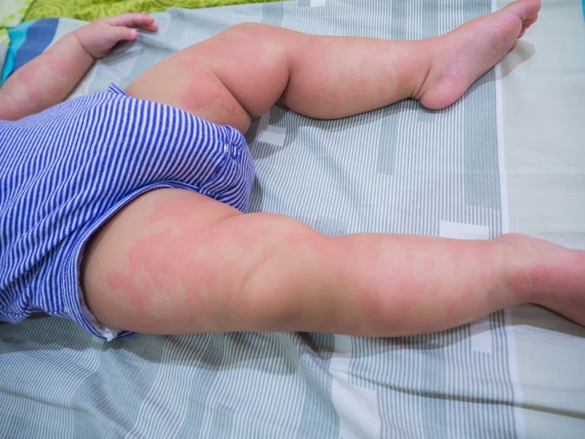 Baby with symptoms of itchy urticaria.