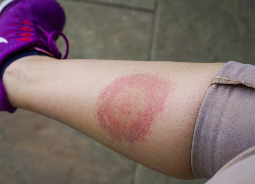 Lyme disease, Borreliosis or Borrelia, typical lyme rash, spot. A person, leg bitten by a deer tick....