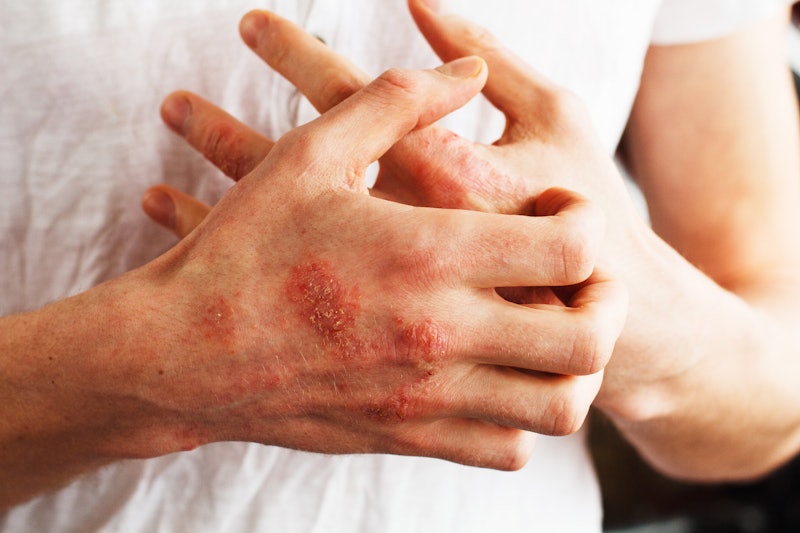 Man scratch oneself, dry flaky skin on hand with psoriasis vulgaris, eczema and other skin condition...
